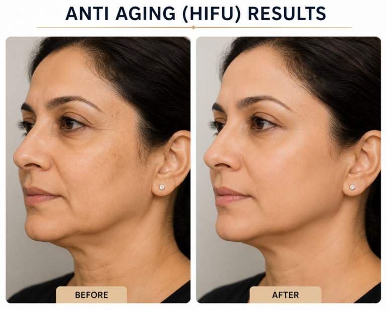 Anti Aging ( HIFU)