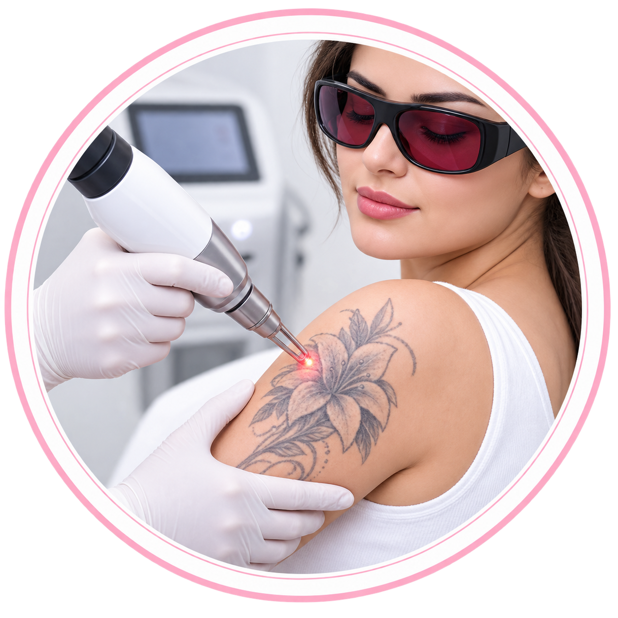 Tattoo Removal